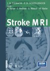 Stroke MRI