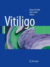 Vitiligo