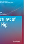 Fractures of the Hip