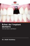 Échec de l¿implant dentaire