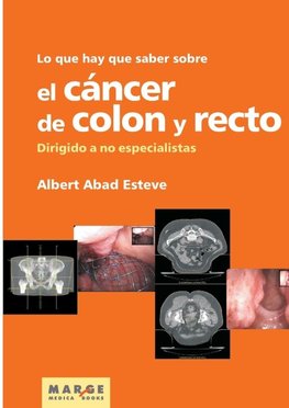 Lo que hay que saber sobre el cáncer de colon y recto