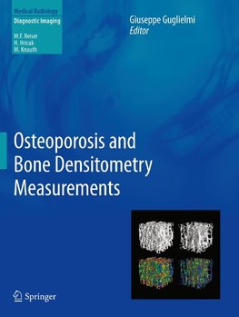 Osteoporosis and Bone Densitometry Measurements