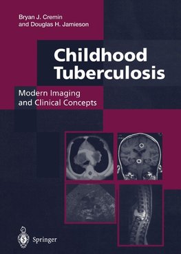 Childhood Tuberculosis: Modern Imaging and Clinical Concepts