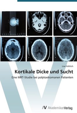 Kortikale Dicke und Sucht