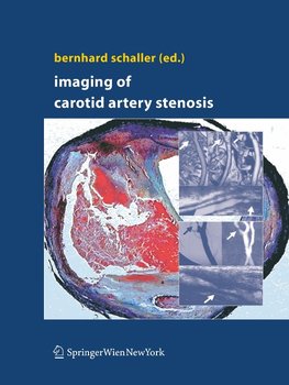 Imaging of Carotid Artery Stenosis