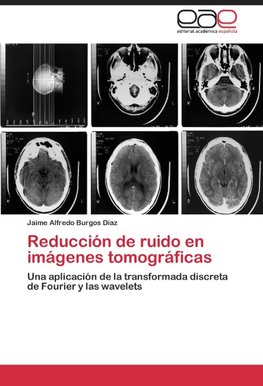 Reducción de ruido en imágenes tomográficas