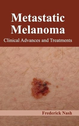 Metastatic Melanoma