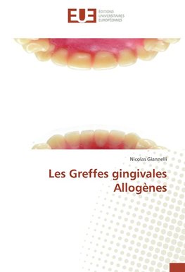 Les Greffes gingivales Allogènes