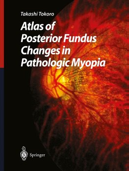 Atlas of Posterior Fundus Changes in Pathologic Myopia • Eurobooks