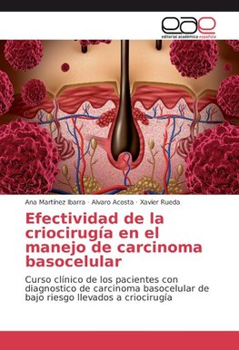 Efectividad de la criocirugía en el manejo de carcinoma basocelular