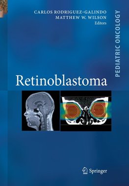 Retinoblastoma