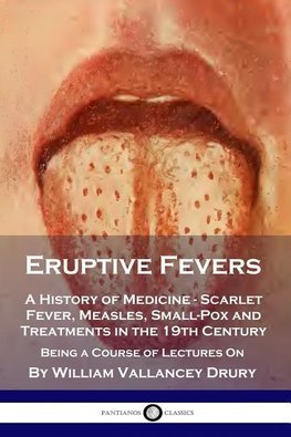 Eruptive Fevers