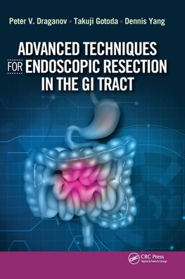 Advanced Techniques for Endoscopic Resection in the GI Tract