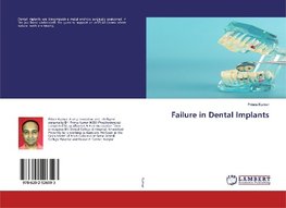 Failure in Dental Implants