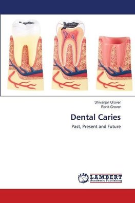 Dental Caries