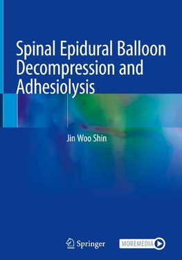 Spinal Epidural Balloon Decompression and Adhesiolysis