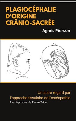 plagiocéphalie d'origine crânio-sacrée