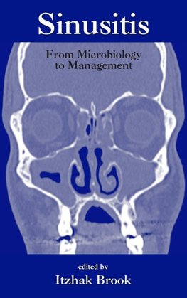 Sinusitis