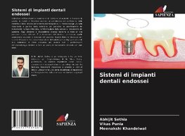 Sistemi di impianti dentali endossei