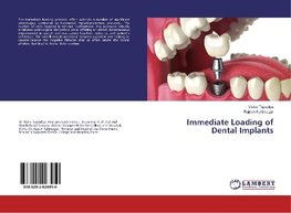 Immediate Loading of Dental Implants