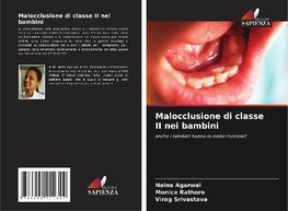 Malocclusione di classe II nei bambini