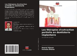 Les thérapies d'extraction partielle en dentisterie implantaire