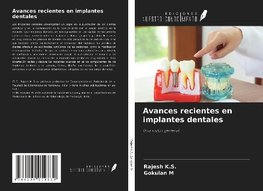 Avances recientes en implantes dentales