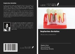 Implantes dentales