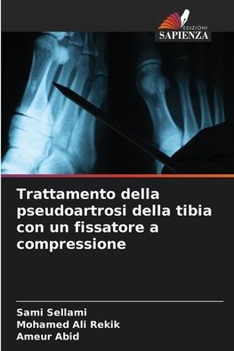 Trattamento della pseudoartrosi della tibia con un fissatore a compressione