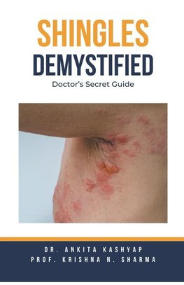 Shingles Demystified