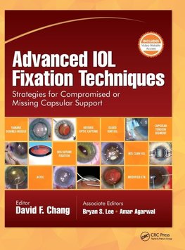 Advanced IOL Fixation Techniques