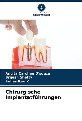 Chirurgische Implantatführungen