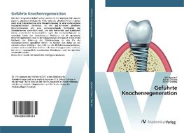 Geführte Knochenregeneration