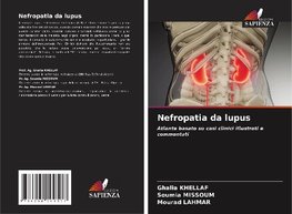 Nefropatia da lupus