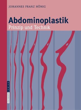 Abdominoplastik